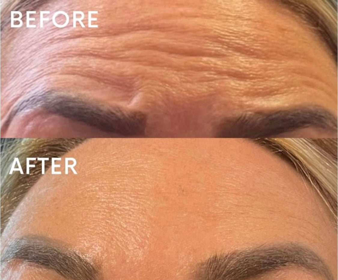 Botox Gosforth Newcastle Upon Tyne