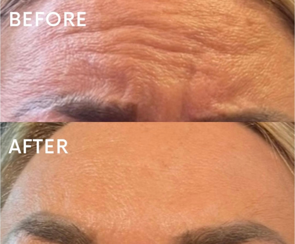 Botox Allergan - 1 Area