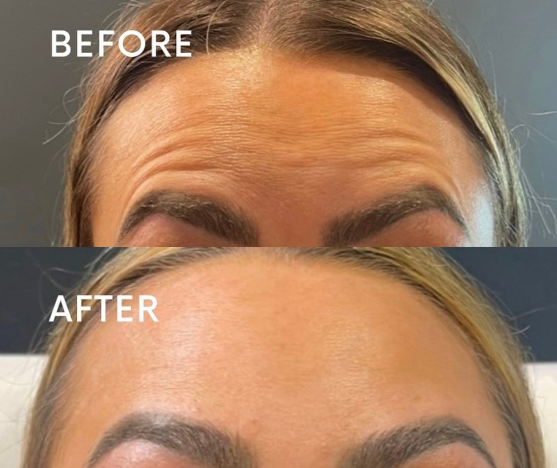 Botox by advanced practitioner Kate at Beauty At Gosforth Park, Newcastle Upon Tyne