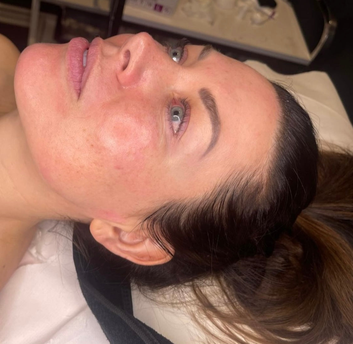 Microneedling by Advanced Aesthetics Practitioner at Beauty At Gosforth Park, Gosforth, Newcastle Upon Tyne