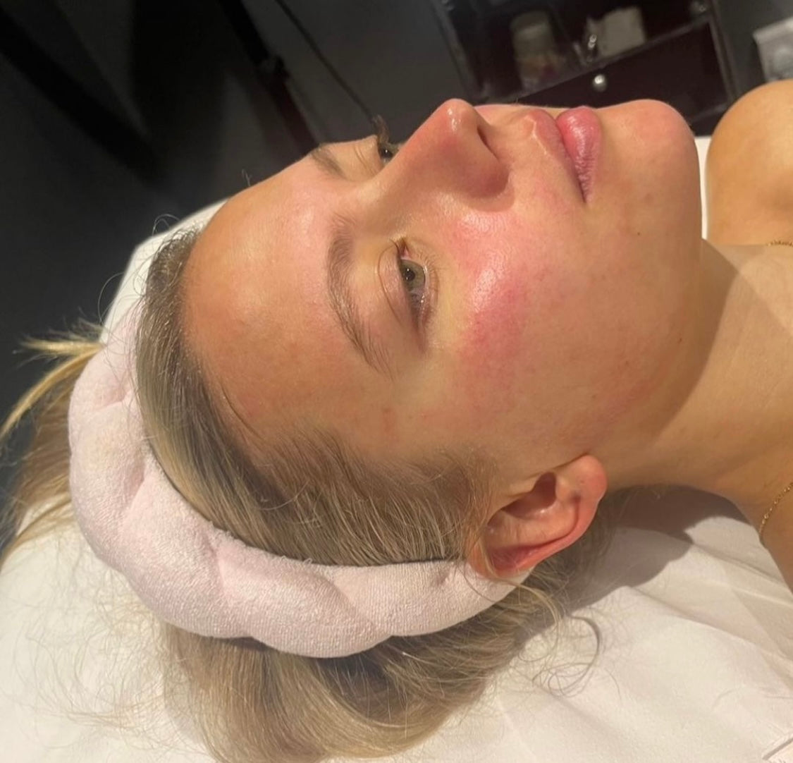 Microneedling by Advanced Practitioner Kate at Beauty At Gosforth Park, Gosforth, Bewcastle Upon Tyne