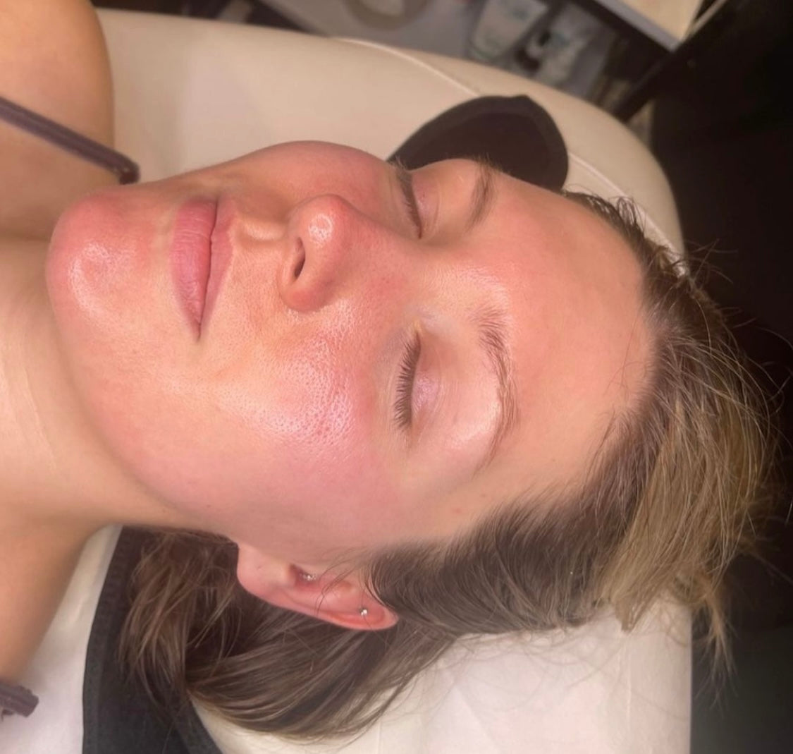 Microneedling by Advanced Aesthetics Practitioner Kate at Beauty At Gosforth Park, Gosforth Newcastle Upon Tyne