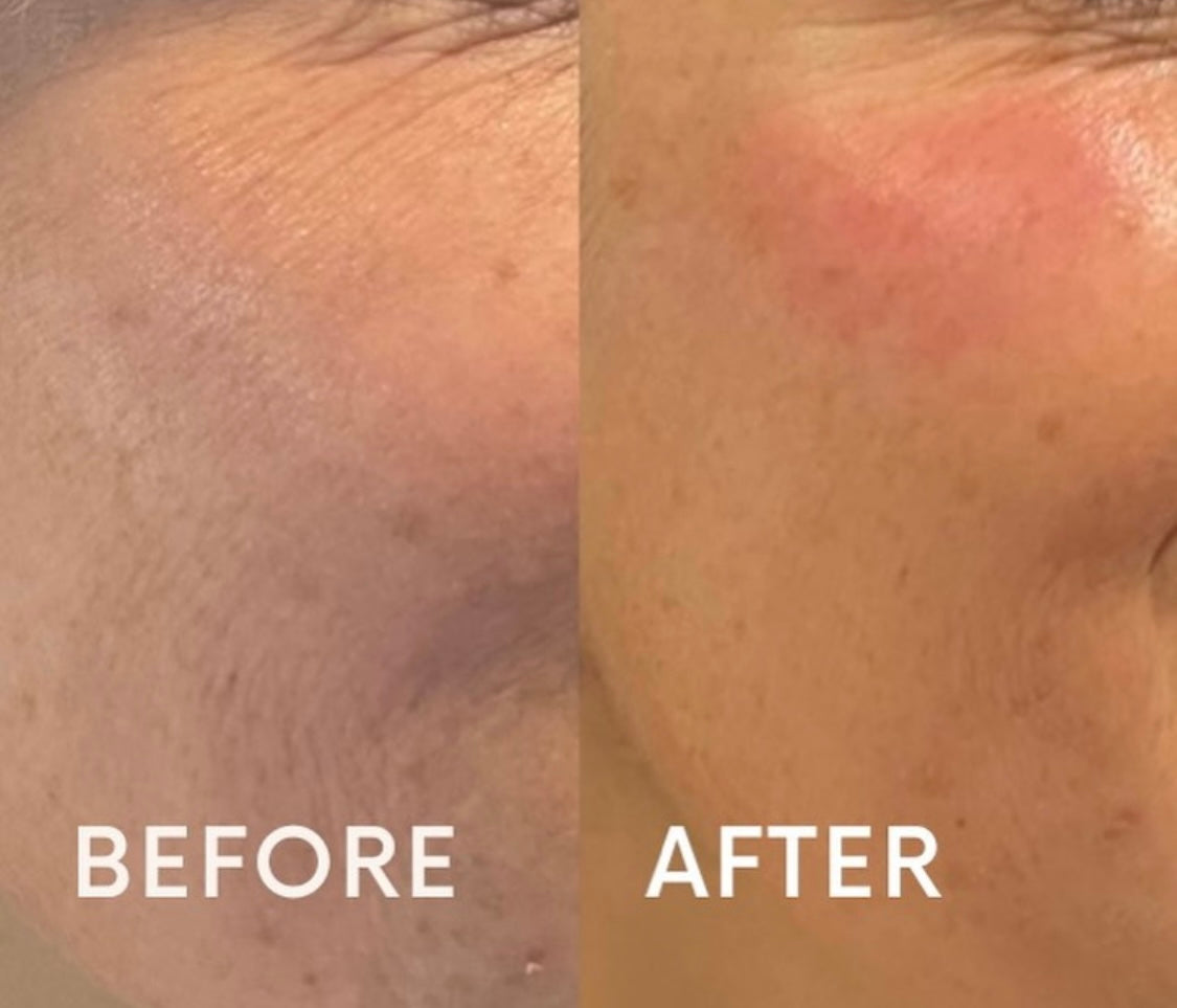 Microneedling by Advanced Practitioner Kate at Beauty At Gosforth Park, Gosforth, Newcastle