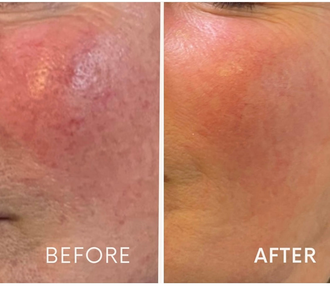 Microneedling At Beauty At Gosforth Park, Gosforth, Newcastle Upon Tyne