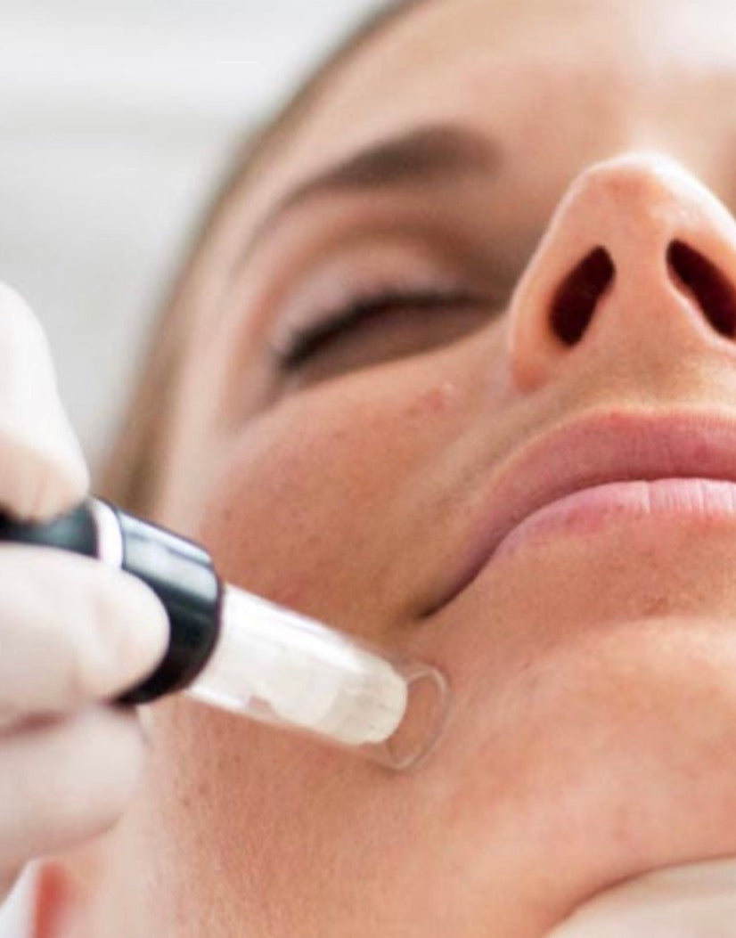 Microneedling Gosforth Newcastle | Microneedling Gosforth | Microneedling Ponteland 